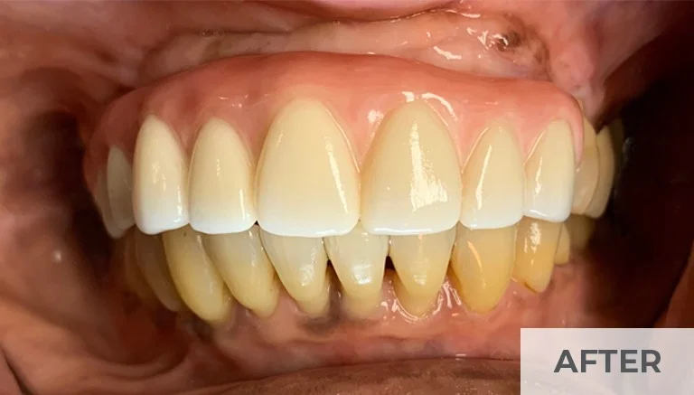 After — full arch upper restoration at Complete Family Dentistry