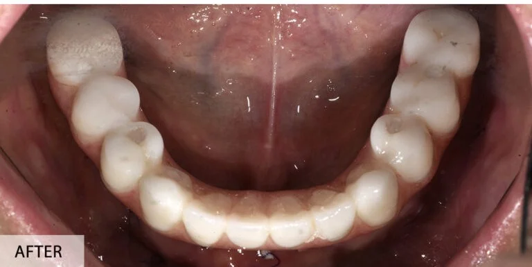 After — full arch lower restoration with restored bite function
