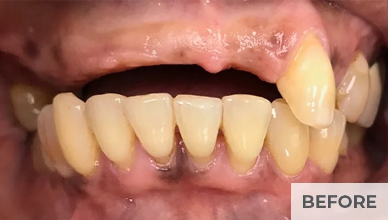 Before — full arch upper restoration at Complete Family Dentistry