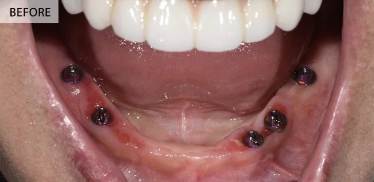 Before — full arch lower restoration at Complete Family Dentistry